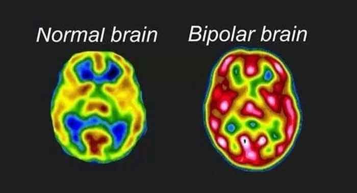 نقشه مغزی اختلال دوقطبی چگونه است