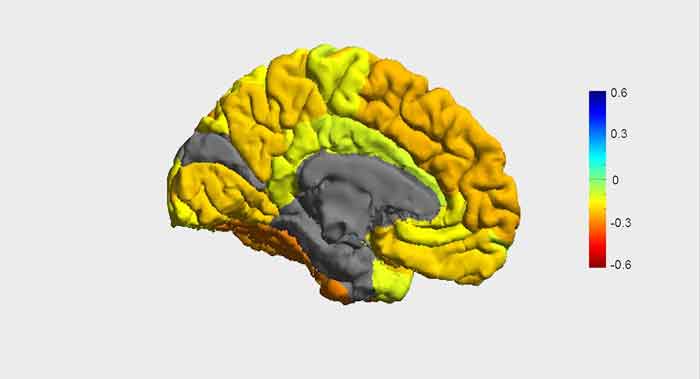 امواج مغزی در افراد مبتلا به دوقطبی