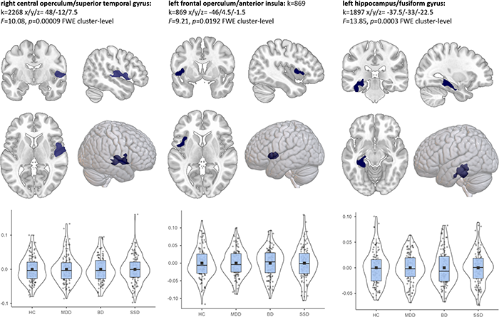 تفاوت مغز افسرده با مغز سالم