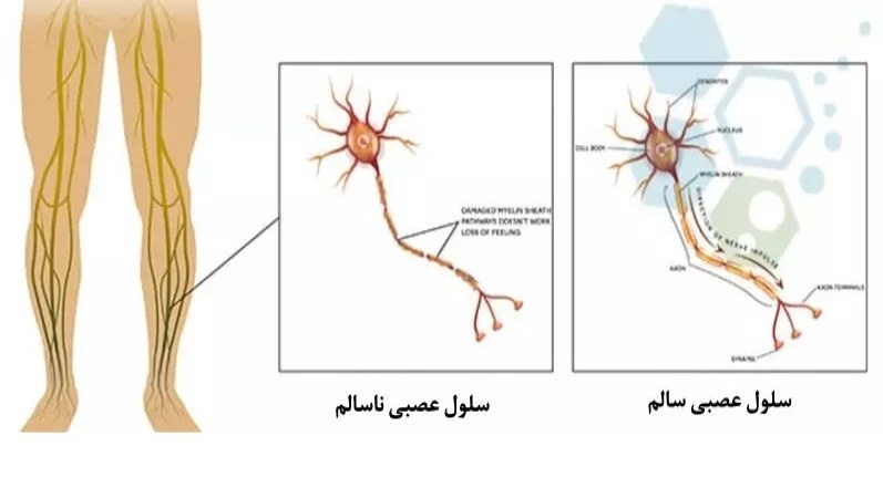 علائم نوروپاتی محیطی