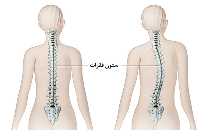 مقایسه اسکولیوز با ستون فقرات عادی