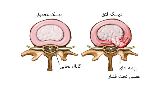 تفاوت فتق دیسک کمر با دیسک معمولی و سالم
