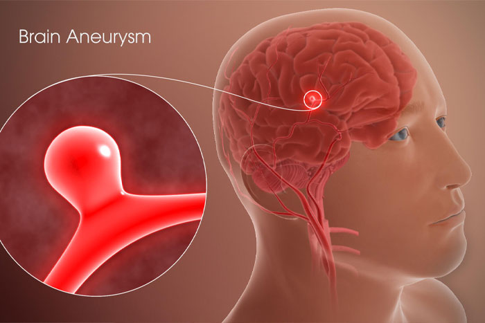 بیماری آنوریسم مغزی و علل آن