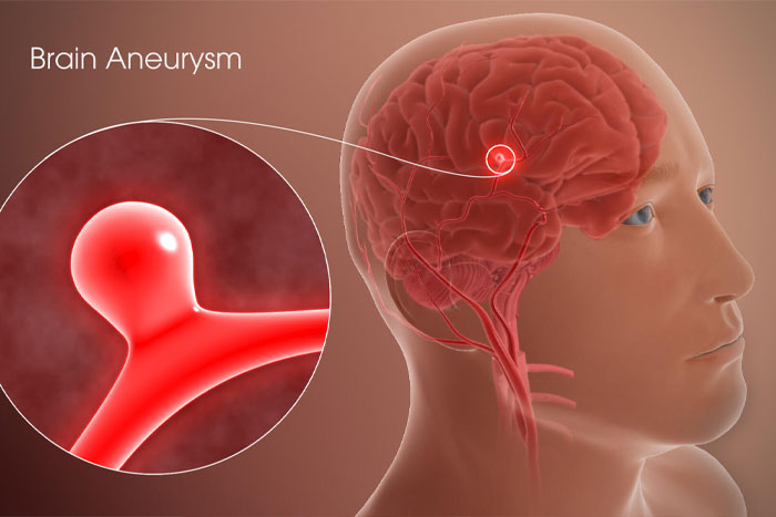 بیماری آنوریسم مغزی