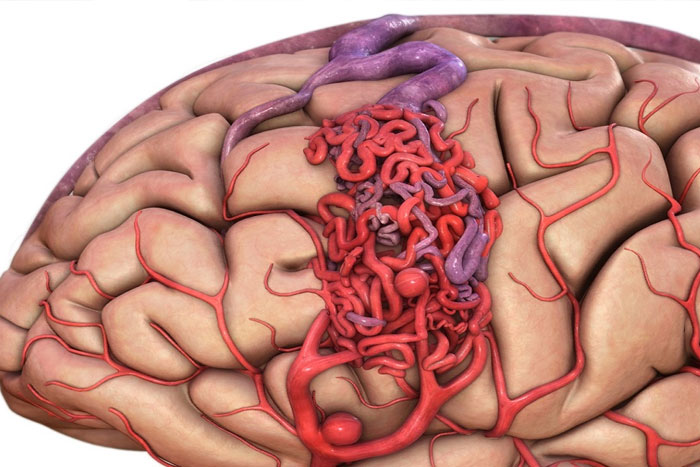 آنوریسم مغزی چیست
