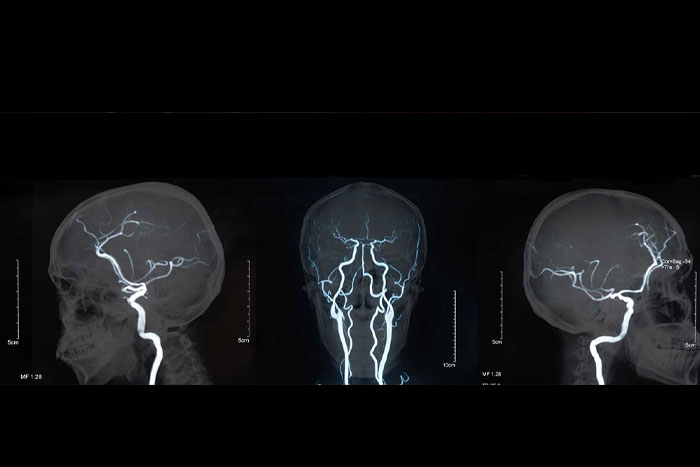 آنژیوگرافی مغزی