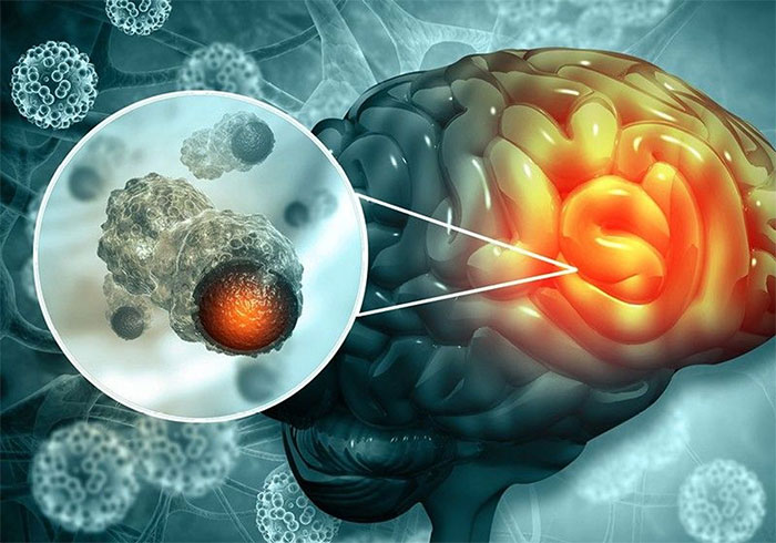تفاوت تومور مغزی خوش خیم و بدخیم