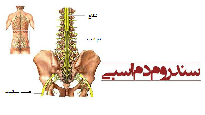 سندروم دم اسبی