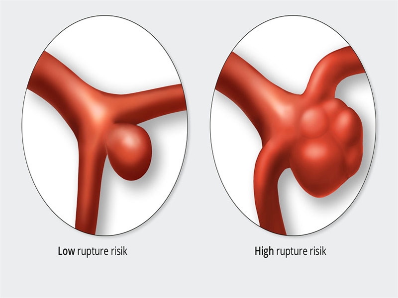 هر آنچه که باید در مورد آنوریسم مغزی بدانید