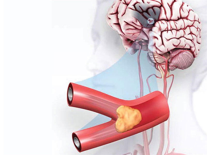 سکته مغزی چیست؟ علائم، علت، تشخیص و درمان
