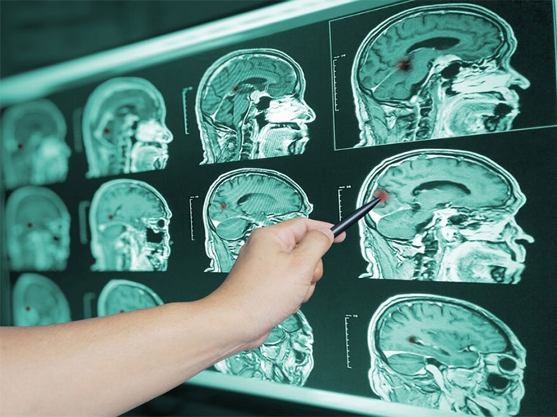 ضربه مغزی چیست و چه علائمی دارد؟