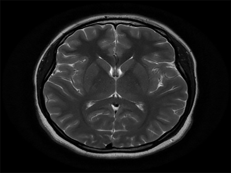 نقشه مغزی فرد افسرده و تفسیر آن