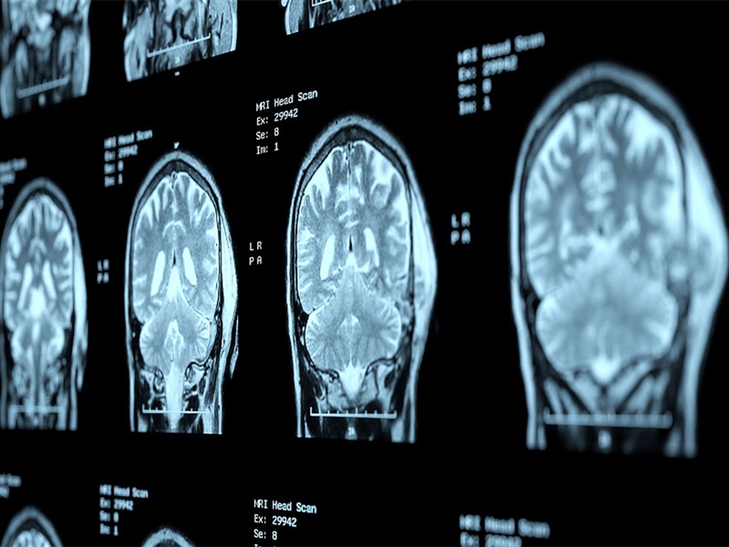 تومور مغزی چیست؛ انواع و روش های درمان تومور سر